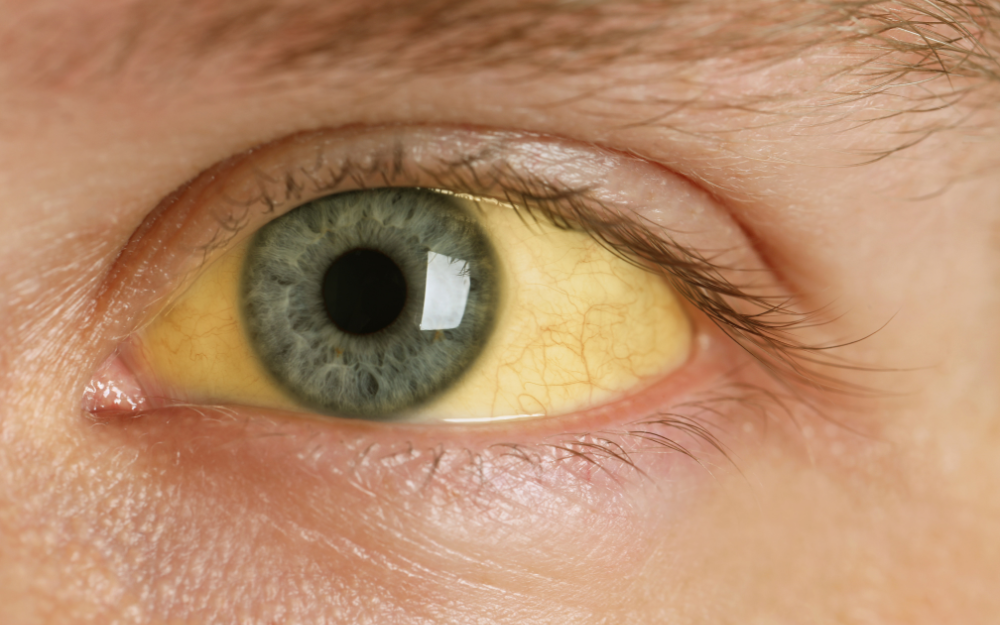 Da và mắt bị vàng là dấu hiệu của bệnh gì?