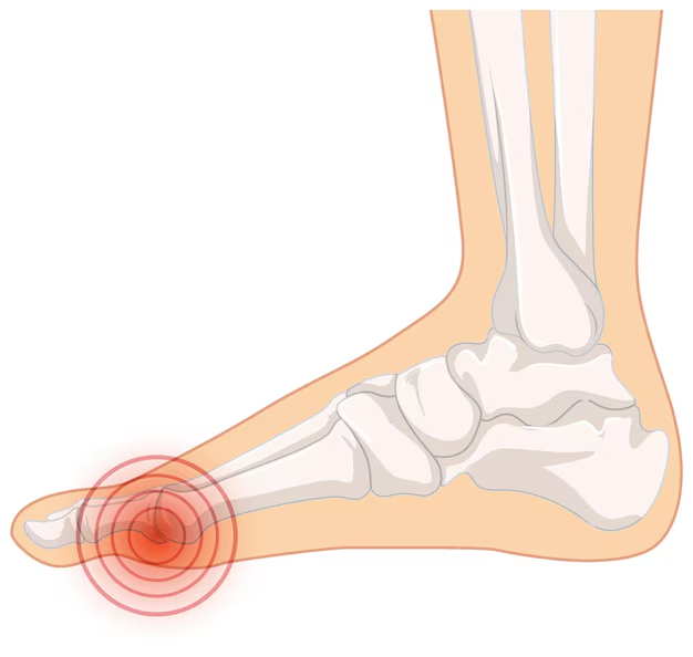 Cách Chăm Sóc Người Bệnh Gút: Dấu Hiệu Nhận Biết & Các Giai Đoạn Của Bệnh