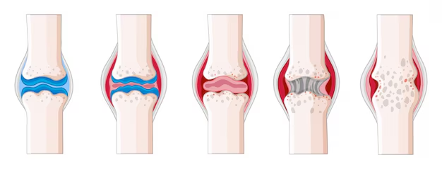 Cách Chăm Sóc Người Bệnh Gút: Dấu Hiệu Nhận Biết & Các Giai Đoạn Của Bệnh